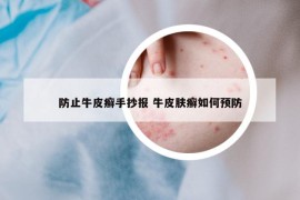 防止牛皮癬手抄報 牛皮膚癬如何預防
