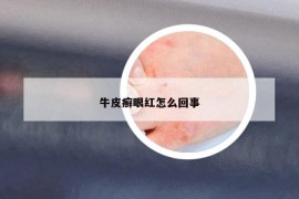 牛皮癬眼紅怎么回事