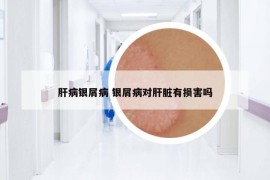 肝病銀屑病 銀屑病對肝臟有損害嗎