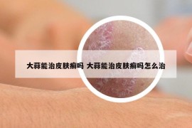 大蒜能治皮膚癬嗎 大蒜能治皮膚癬嗎怎么治