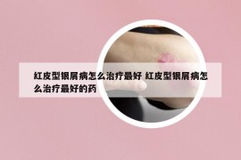 紅皮型銀屑病怎么治療最好 紅皮型銀屑病怎么治療最好的藥