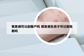 銀屑病可以剖腹產(chǎn)嗎 銀屑病生孩子可以做隔斷嗎