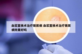 血漿置換術(shù)治療銀屑病 血漿置換術(shù)治療銀屑病效果好嗎