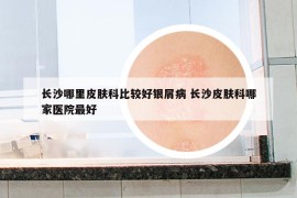 長沙哪里皮膚科比較好銀屑病 長沙皮膚科哪家醫(yī)院最好
