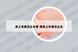 身上生癬怎么會(huì)事 我身上長(zhǎng)癬怎么辦