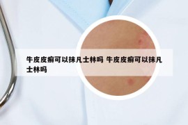 牛皮皮癬可以抹凡士林嗎 牛皮皮癬可以抹凡士林嗎