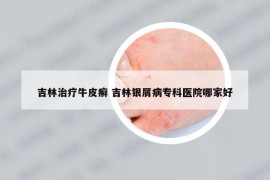 吉林治療牛皮癬 吉林銀屑病?？漆t(yī)院哪家好