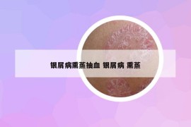 銀屑病熏蒸抽血 銀屑病 熏蒸