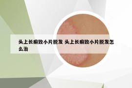 頭上長癬致小片脫發(fā) 頭上長癬致小片脫發(fā)怎么治