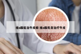 維a酸能治牛皮癬 維a酸乳膏治療牛皮