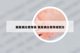 銀屑病分類等級 銀屑病分類等級劃分