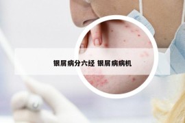 銀屑病分六經 銀屑病病機