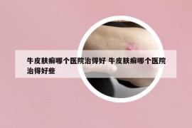 牛皮膚癬哪個(gè)醫(yī)院治得好 牛皮膚癬哪個(gè)醫(yī)院治得好些