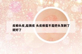 皮癬頭皮,能撕皮 頭皮癬是不是把頭發(fā)剃了就好了