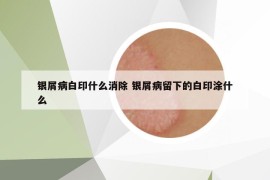 銀屑病白印什么消除 銀屑病留下的白印涂什么