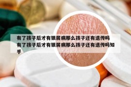 有了孩子后才有銀屑病那么孩子還有遺傳嗎 有了孩子后才有銀屑病那么孩子還有遺傳嗎知乎