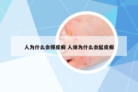 人為什么會得皮癬 人體為什么會起皮癬