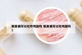 銀屑病可以吃炸雞腿嗎 銀屑病可以吃雞腿嗎?