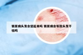 銀屑病頭發(fā)會豎起來嗎 銀屑病會導致頭發(fā)干枯嗎