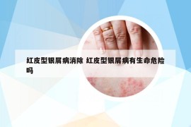 紅皮型銀屑病消除 紅皮型銀屑病有生命危險嗎