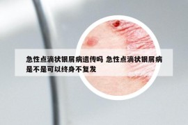 急性點(diǎn)滴狀銀屑病遺傳嗎 急性點(diǎn)滴狀銀屑病是不是可以終身不復(fù)發(fā)