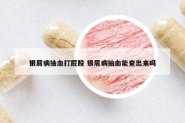 銀屑病抽血打屁股 銀屑病抽血能查出來嗎