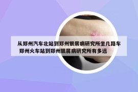 從鄭州汽車北站到鄭州銀屑病研究所坐幾路車 鄭州火車站到鄭州銀屑病研究所有多遠