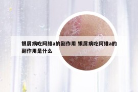 銀屑病吃阿維a的副作用 銀屑病吃阿維a的副作用是什么