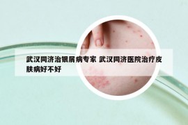 武漢同濟(jì)治銀屑病專家 武漢同濟(jì)醫(yī)院治療皮膚病好不好