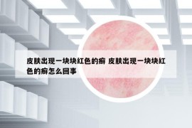 皮膚出現(xiàn)一塊塊紅色的癬 皮膚出現(xiàn)一塊塊紅色的癬怎么回事
