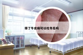 得了牛皮癬可以吃冬瓜嗎