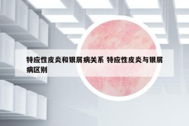特應(yīng)性皮炎和銀屑病關(guān)系 特應(yīng)性皮炎與銀屑病區(qū)別