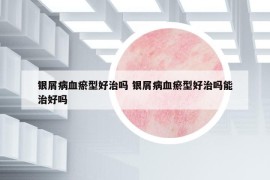 銀屑病血瘀型好治嗎 銀屑病血瘀型好治嗎能治好嗎