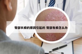臀部長癬的原因引起的 臀部有癬怎么辦