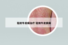 輕的牛皮癬治療 輕微牛皮膚癬