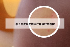 患上牛皮癬怎樣治療比較好的醫(yī)院
