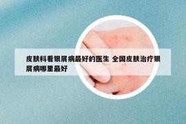 皮膚科看銀屑病最好的醫(yī)生 全國皮膚治療銀屑病哪里最好