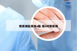 銀屑病能用維a酸 維a對銀屑病