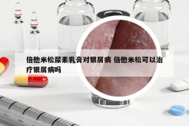 倍他米松尿素乳膏對銀屑病 倍他米松可以治療銀屑病嗎