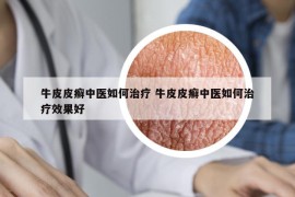 牛皮皮癬中醫(yī)如何治療 牛皮皮癬中醫(yī)如何治療效果好