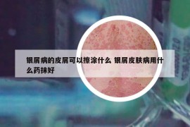 銀屑病的皮屑可以擦涂什么 銀屑皮膚病用什么藥抹好