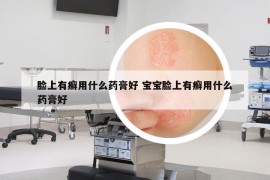 臉上有癬用什么藥膏好 寶寶臉上有癬用什么藥膏好