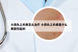 小孩頭上長(zhǎng)癬怎么治療 小孩頭上長(zhǎng)癬是什么原因引起的