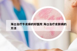 海口治療牛皮癬的好醫(yī)院 ?？谥委熎つw病的方法