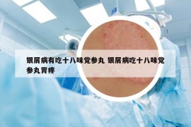 銀屑病有吃十八味黨參丸 銀屑病吃十八味黨參丸胃疼