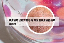 銀屑病可以用蘆薈皂嗎 尋常型銀屑病能擦蘆薈膠嗎