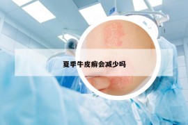 夏季牛皮癬會減少嗎