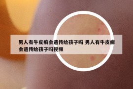 男人有牛皮癬會(huì)遺傳給孩子嗎 男人有牛皮癬會(huì)遺傳給孩子嗎視頻