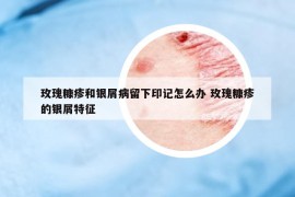 玫瑰糠疹和銀屑病留下印記怎么辦 玫瑰糠疹的銀屑特征