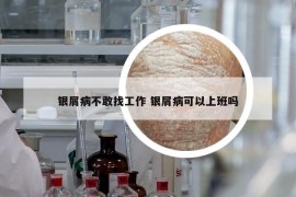 銀屑病不敢找工作 銀屑病可以上班嗎